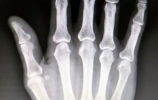 mano después / hand after qi gong